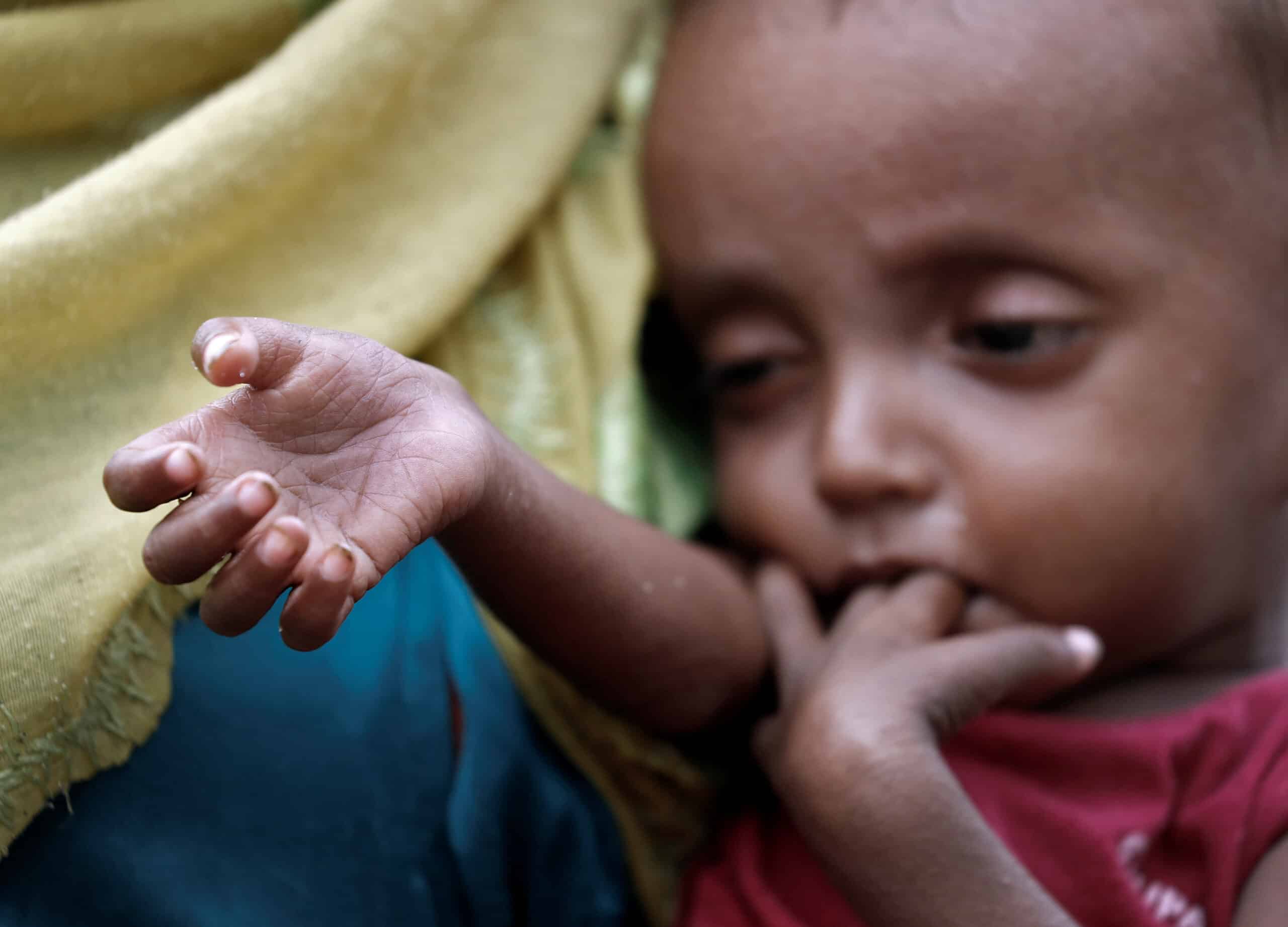 أطفال الروهنغيا.. بين مطرقة الفرار وسندان سوء التغذية