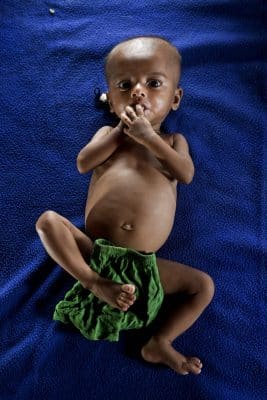 صور.. سوء التغذية يهدد حياة أطفال الروهنغيا في مخيمات بنغلادش