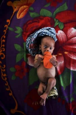 صور.. سوء التغذية يهدد حياة أطفال الروهنغيا في مخيمات بنغلادش