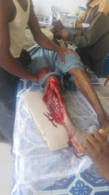 سيارة حكومية تدهس رجلا روهنغيا بشكل متعمد وتمزق إحدى رجليه