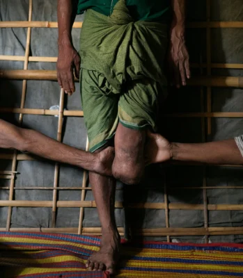 روهنجي فقد ساقه جراء ضربات الطائرت دون طيار التابعة لجيش أراكان في أغسطس 2024 (صورة: NYTimes)