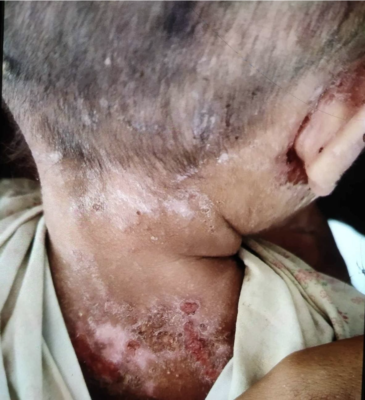 الأمراض الجلدية تلتهم أجساد الأطفال في ولاية أراكان (صورة: Mizzima)