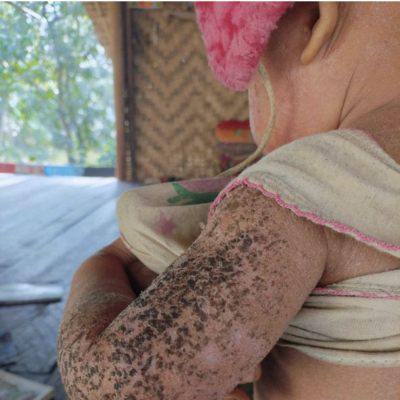 الأمراض الجلدية تلتهم أجساد الأطفال في ولاية أراكان (صورة: Mizzima)