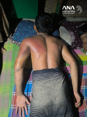 اختطاف اثنين من لاجئي الروهينجا من قبل شرطيين مزيفين في بنغلادش 1 آثار التعذيب على جسد أحد اللاجئين المختطفين (صورة: ANA)